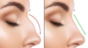 Rhinoplasty Surgery in Bangalore