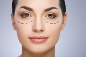 Blepharoplasty in Bangalore