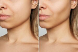 Buccal fat pad removal