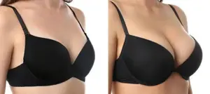 Breast Augmentation Surgery