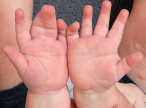Congenital