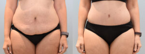 Tummy Tuck Scars