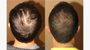 Hair Transplants