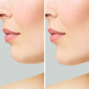 Chin Augmentation